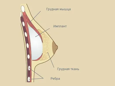 Dr. Andreas Skarparis Plastic and Hand Surgeon Cyprus | Calf Implants