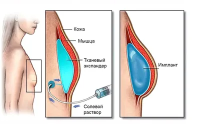Увеличение груди круглыми имплантами в Москве » Сила в ПРАВДЕ: Актуальные  международные новости