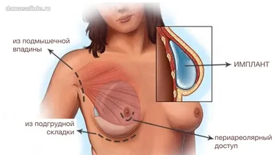 Увеличение молочных желез под мышцу - Вирабян Л. В.