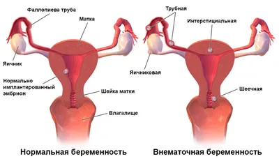 Внематочная беременность: симптомы, признаки, причины, лечение, диагностика