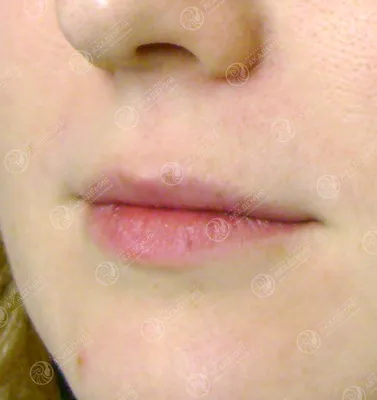 Коррекция губ гиалуроновой кислотой. Корректировать форму губ в клинике  \