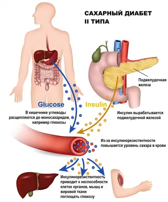 Сахарный диабет II типа - причины появления, симптомы заболевания,  диагностика и способы лечения