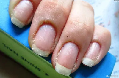 Болезни ногтей после гель лака - 41 фото