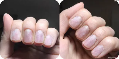 Болезни ногтей после гель лака - 41 фото