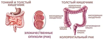 Рак кишечника, признаки, симптомы, стадии. Лечение рака кишки