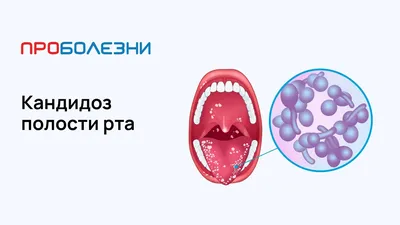 Кандидоз полости рта: причины, симптомы и лечение в статье детского  стоматолога Федоряк О. А.