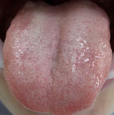 Кандидоз полости рта: симптомы и лечение