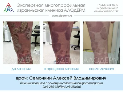 Лечение каплевидного псориаза в Москве | Клиника АЛОДЕРМ , Москва