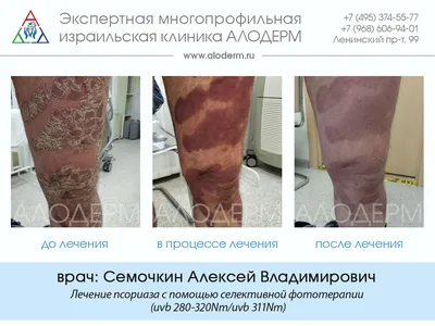 Лечение псориаза в Москве - фото до и после | Клиника АЛОДЕРМ , Москва