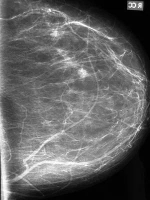 Инвазивная протоковая карцинома (invasive ductal carcinoma) | Радиография