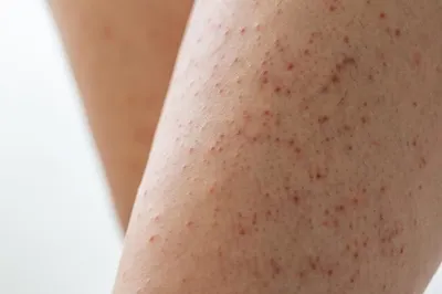 Столбчатый кератоз на ногах молодой женщины шелушение кожи с красными  пятнами | Премиум Фото