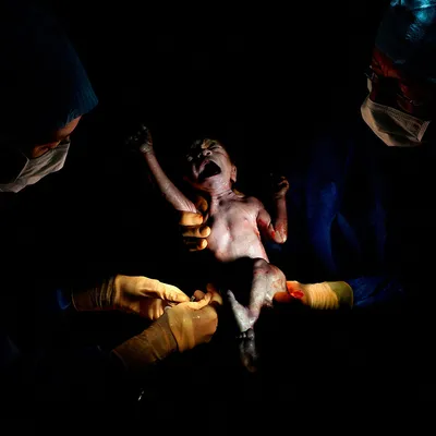 Фото новорожденных сразу после кесарева сечения