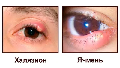 Халязион на веке: лечение, удаление, причины халязиона на глазу