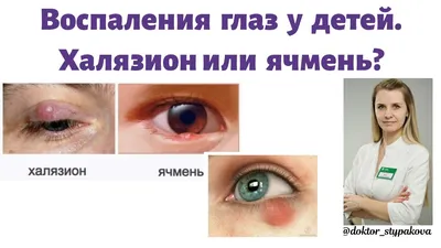 Воспаление глаз у детей.Халязион у детей.Как отличить халязион от ячменя? -  YouTube