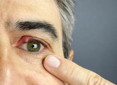 Крупный план мужского глазного ячменя офтальмологическая болезнь ячменя  халязион | Премиум Фото