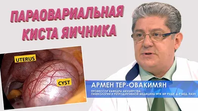 Параовариальная киста - признаки, причины, симптомы, лечение и профилактика  - iDoctor.kz