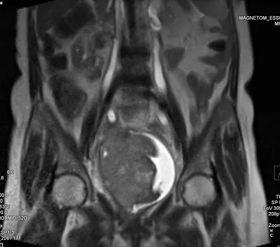 МРТ кист и поликистоза яичника - протокол, признаки на МРТ снимках