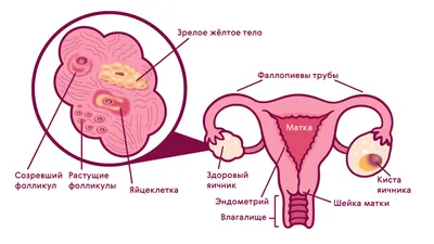 Киста яичника: симптомы у женщин и девушек, признаки кисты, причины  появления, лечение