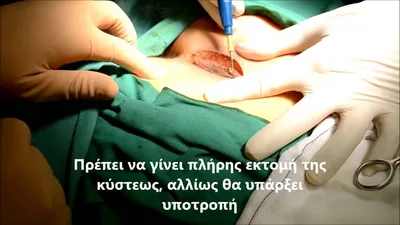 Пилонидальная киста (синус) | Plastic Surgery Cyprus | Plastic Surgeon  Cyprus