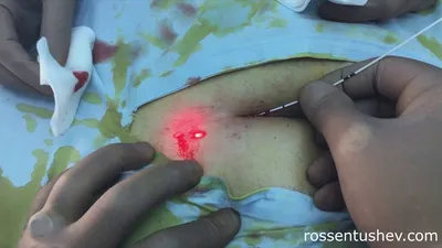 Лазерно лечение на пилонидална киста | Д-р Росен Тушев - YouTube