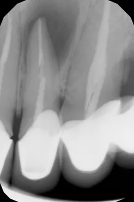 Киста зуба - Вопрос стоматологу - 03 Онлайн