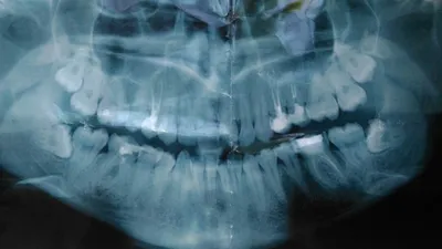 Киста зуба или нет - Вопрос стоматологу - 03 Онлайн