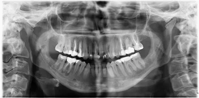 Киста зуба - Вопрос стоматологу - 03 Онлайн