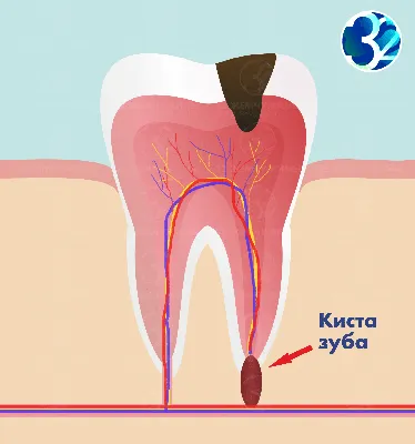 Лечение кисты зуба – «Территория улыбки» в Саратове