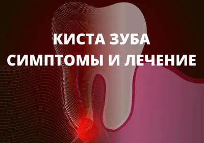 Киста зуба ▷ Симптомы и лечение Киев, Подол ▷ Цена зубной кисты