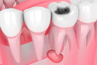 Киста зуба что такое, симптомы, способы лечения