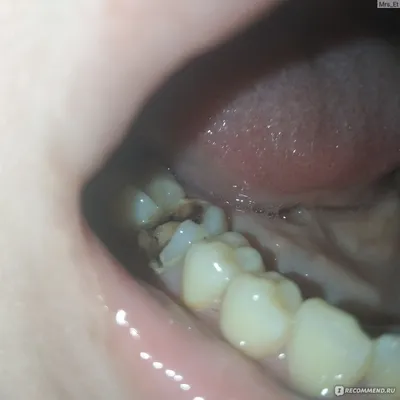 Удаление кисты зуба - «Карательная стоматология: мне выдрали кисту с зубом  НАЖИВУЮ, я выдрала подлокотник от кресла. Затем оказалось, что зуб можно  было спасти😠» | отзывы