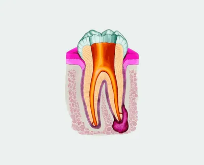 Киста зуба - что это, причины кисты зуба, стадии, симптомы, виды и лечение  кисты