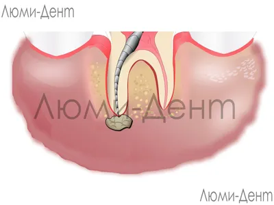 Гранулема 1 Зуба [9 Фото] Лечение Киев Гнойная Корня ЛюмиДент