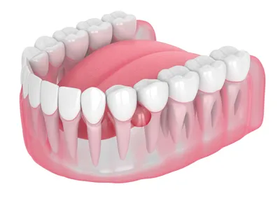 Лечение кисты зуба в СПб, Удаление кисты зуба: цена от 8 000 ₽ в  стоматологии OrthoLove