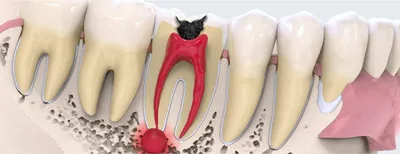 Киста - это всегда удаление зуба? Стоматология Dental Way в Москве и  Московской области | Dental Way