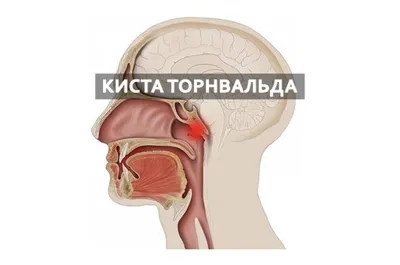 Операция по удалению кисты Торнвальда | отзывы