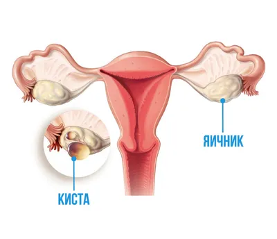 Учёные признают ненужным удаление кисты яичника | Медицинский центр «Татмед»