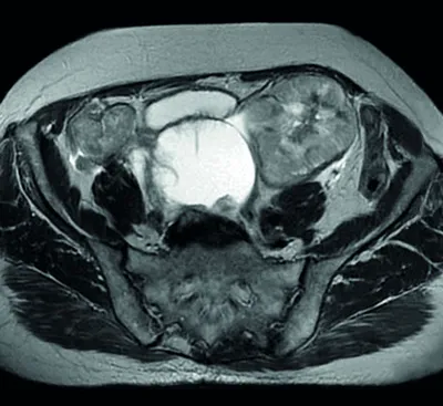 МРТ при кисте яичника - симптомы, признаки, протокол обследования