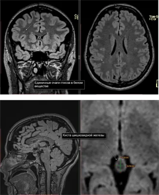 МР-картина кисты шишковидной железы | Второе мнение