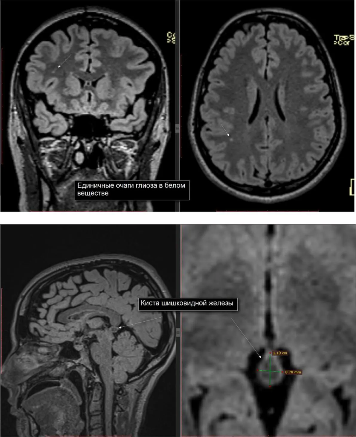 Мрт головного мозга киста шишковидной железы