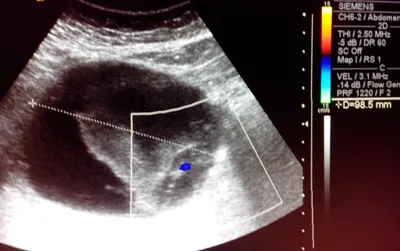 УЗИ диагностика эхинококка печени осложненного кровоизлиянием в полость  кисты