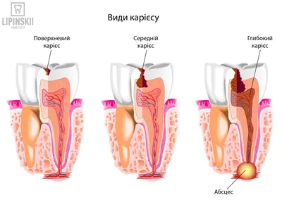 Удаление кисты зуба - стоимость услуги Резекция верхушки корня зуба в  Киеве, Удаление кисты зуба - цена в стоматологии lipinskii.com.ua