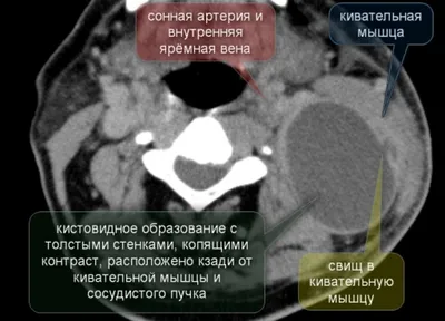 Фиброматоз грудиноключично-сосцевидной мышцы, имитирующий спастическую  кривошею – тема научной статьи по клинической медицине читайте бесплатно  текст научно-исследовательской работы в электронной библиотеке КиберЛенинка