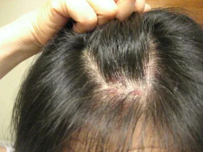 Демодекоз волос головы у человека – схема лечения, шампуни, симптомы и  причины