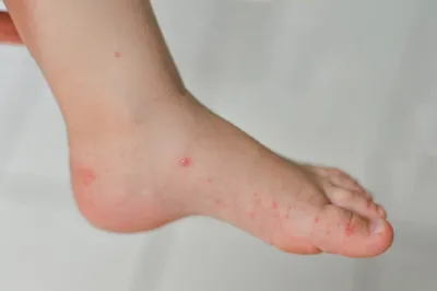 Энтеровирус ноги руки рот сыпь на теле ребенка вирус коксаки | Премиум Фото