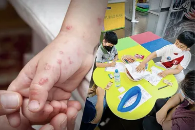 Зарегистрировано 10 случаев заболевания вирусом Коксаки у детей в Уанкайо и  Чупаке - Infobae