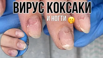 Вирус Коксаки | состояние ногтей - YouTube