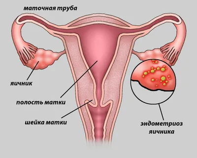 Пять гинекологических заболеваний, от которых не застрахована ни одна  женщина — Аман-Саулык