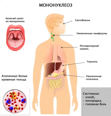 Инфекционный мононуклеоз (болезнь Филатова, железистая лихорадка)