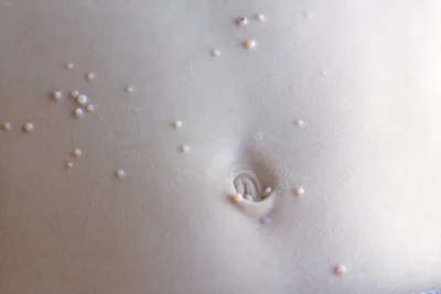 Контагиозный моллюск детский. Лечение - Центр европейской дерматологии